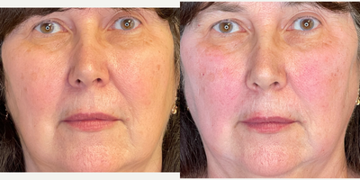 Dermal Fillers before and after photo