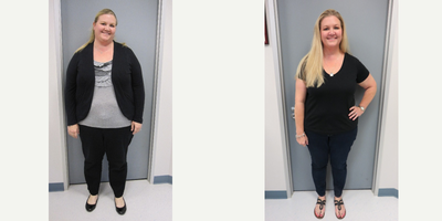 Gastric Sleeve Surgery before and after photo