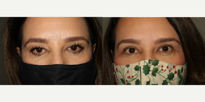 Ptosis Surgery before and after photo