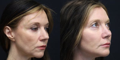 Rhinoplasty before and after photo