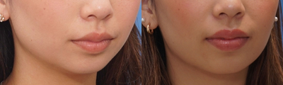 Botox before and after photo