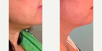 Kybella before and after photo