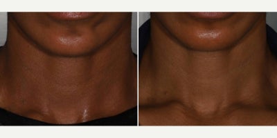 Laser Resurfacing before and after photo