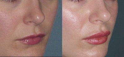 Lip Fillers before and after photo