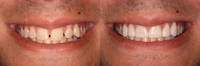 Porcelain Veneers before and after photo