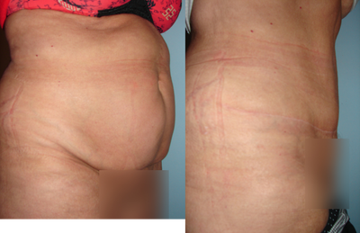 Tummy Tuck before and after photo
