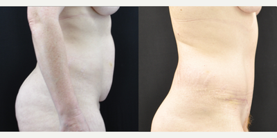 Tummy Tuck before and after photo