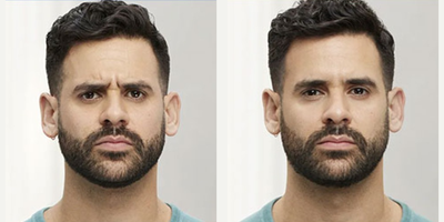Botox before and after photo