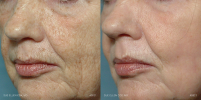 CO2 Laser before and after photo