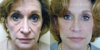 Eyelid Surgery before and after photo