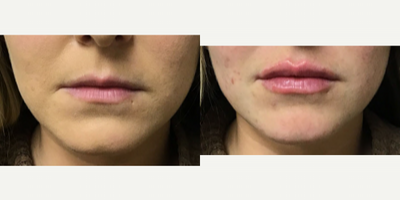 Lip Fillers before and after photo