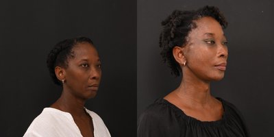 Neck Lift before and after photo