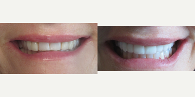 Porcelain Veneers before and after photo