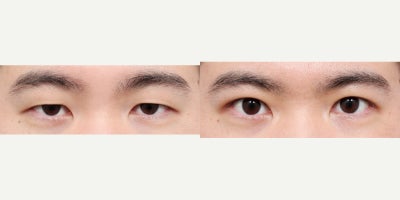 Ptosis Surgery before and after photo