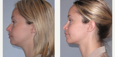 Rhinoplasty before and after photo