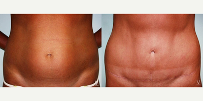 Tummy Tuck before and after photo