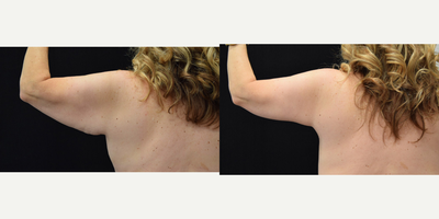 Arm Lift before and after photo