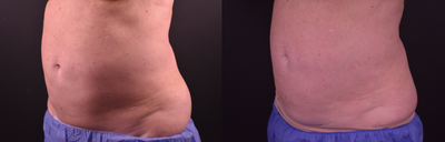 CoolSculpting before and after photo