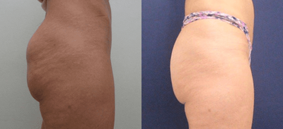 Sculptra before and after photo