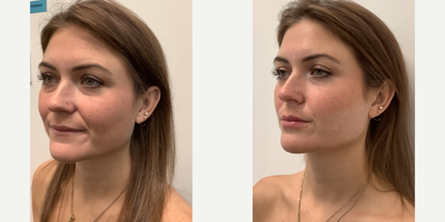 Botox for TMJ before and after photo