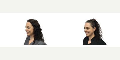 Botox before and after photo