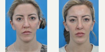 Chin Implant before and after photo