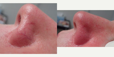 IPL before and after photo