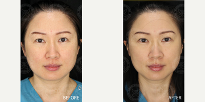 Thermage before and after photo
