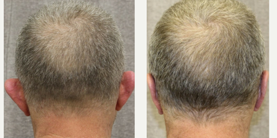 Ear Surgery before and after photo