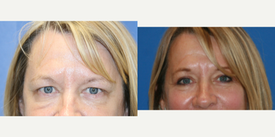 Eyelid Surgery before and after photo
