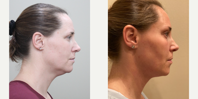 FaceTite before and after photo