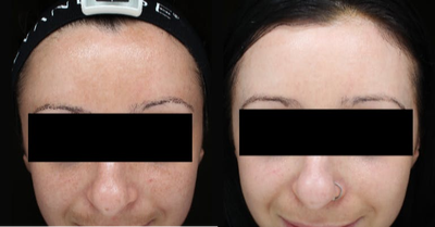 Laser Resurfacing before and after photo