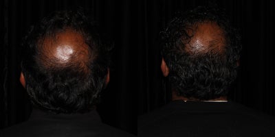 Microneedling before and after photo