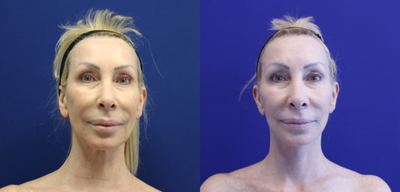Neck Lift before and after photo
