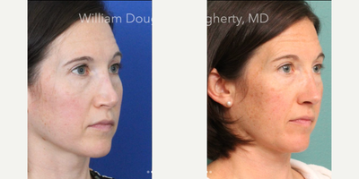 Revision Rhinoplasty before and after photo