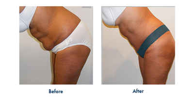 Tummy Tuck before and after photo