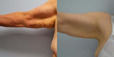 Arm Lift before and after photo