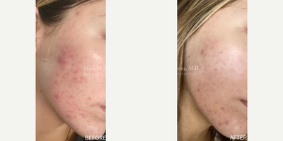 Chemical Peel before and after photo