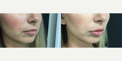 Juvederm before and after photo