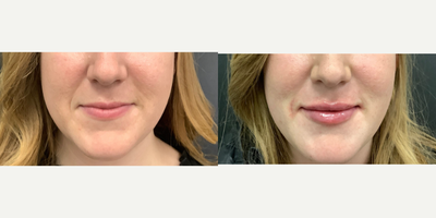Lip Fillers before and after photo