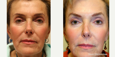 Radiesse before and after photo