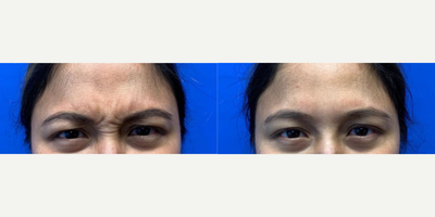 Botox before and after photo