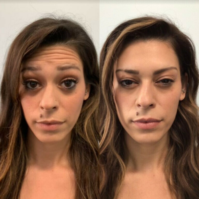 Botox before and after photo