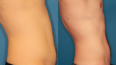 Emsculpt before and after photo
