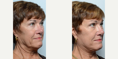 Facelift before and after photo