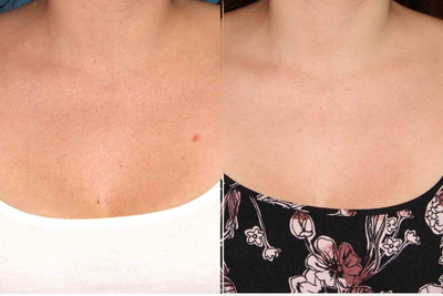 IPL before and after photo