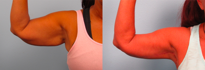 Arm Lift before and after photo