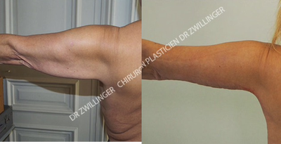 Body Lift before and after photo