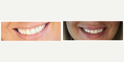 Botox for Gummy Smile before and after photo