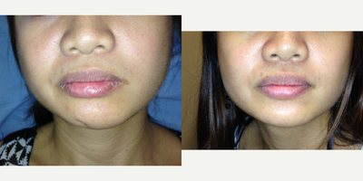 Botox before and after photo
